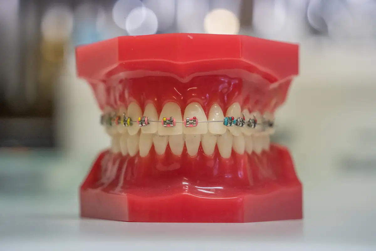 A dental model showing fixed braces with colored elastics